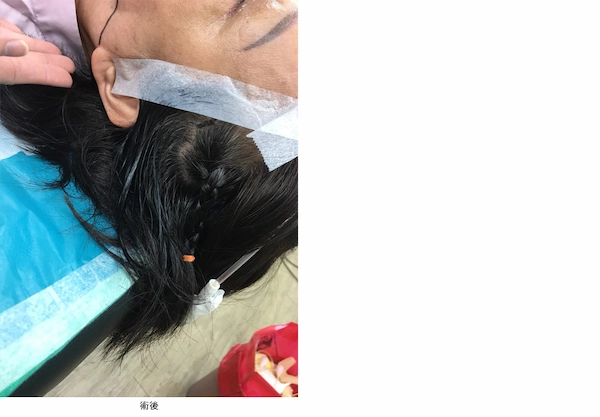 美國鈴鐺線拉提術教學6