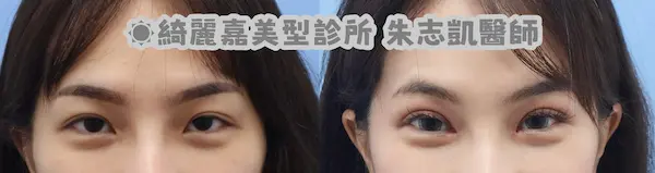 雙眼皮開眼頭