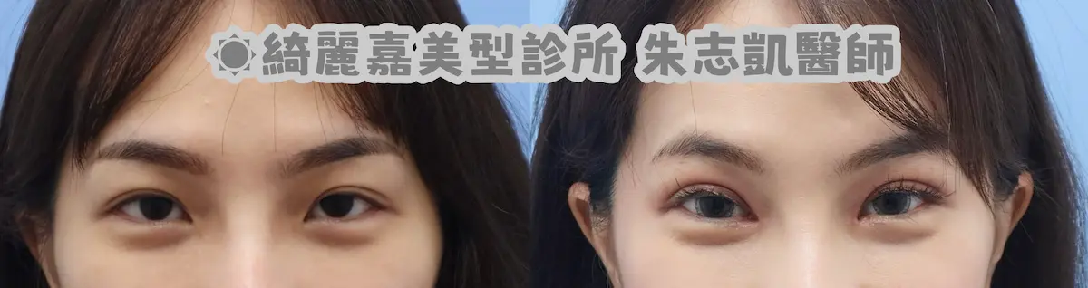 雙眼皮開眼頭 雙眼皮開眼頭