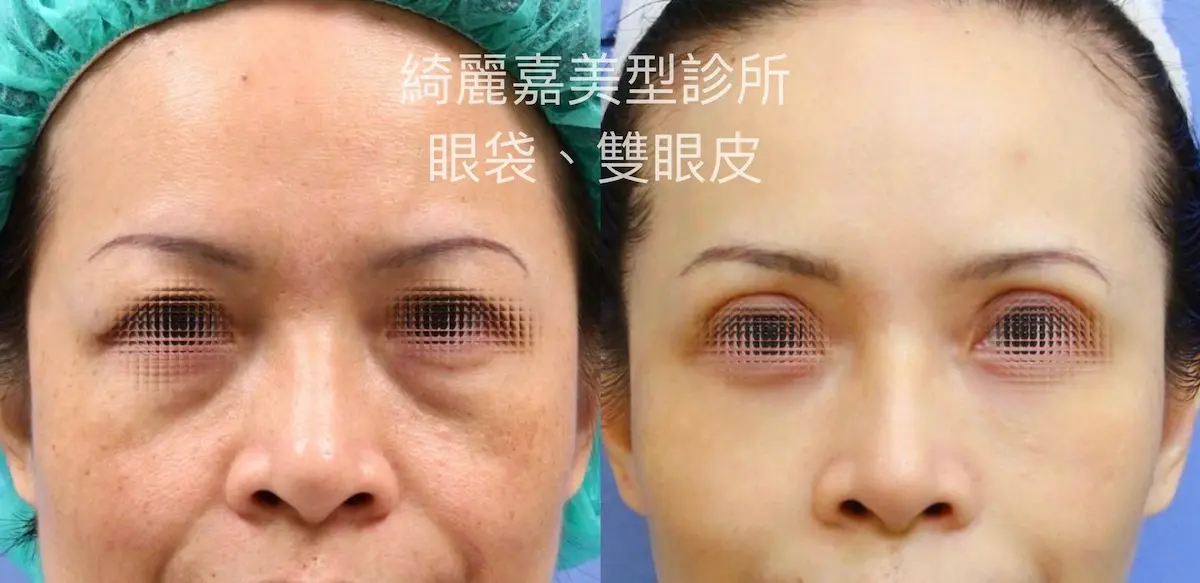 眼袋手術(淚溝改善),消除黑眼圈案例6