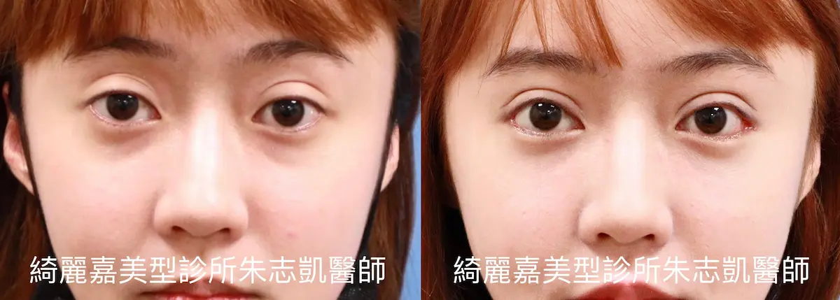重修雙眼皮手術案例四