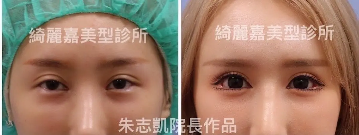 重修雙眼皮手術案例九