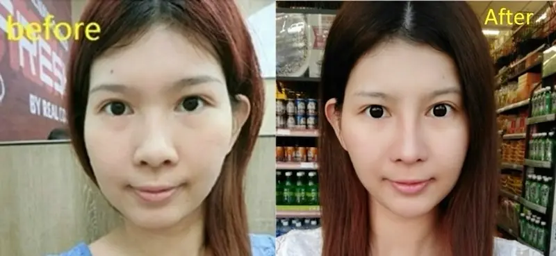 結構性隆鼻 結構性隆鼻 推薦開眼頭,縮鼻翼,鼻頭,微笑唇手術,眼袋