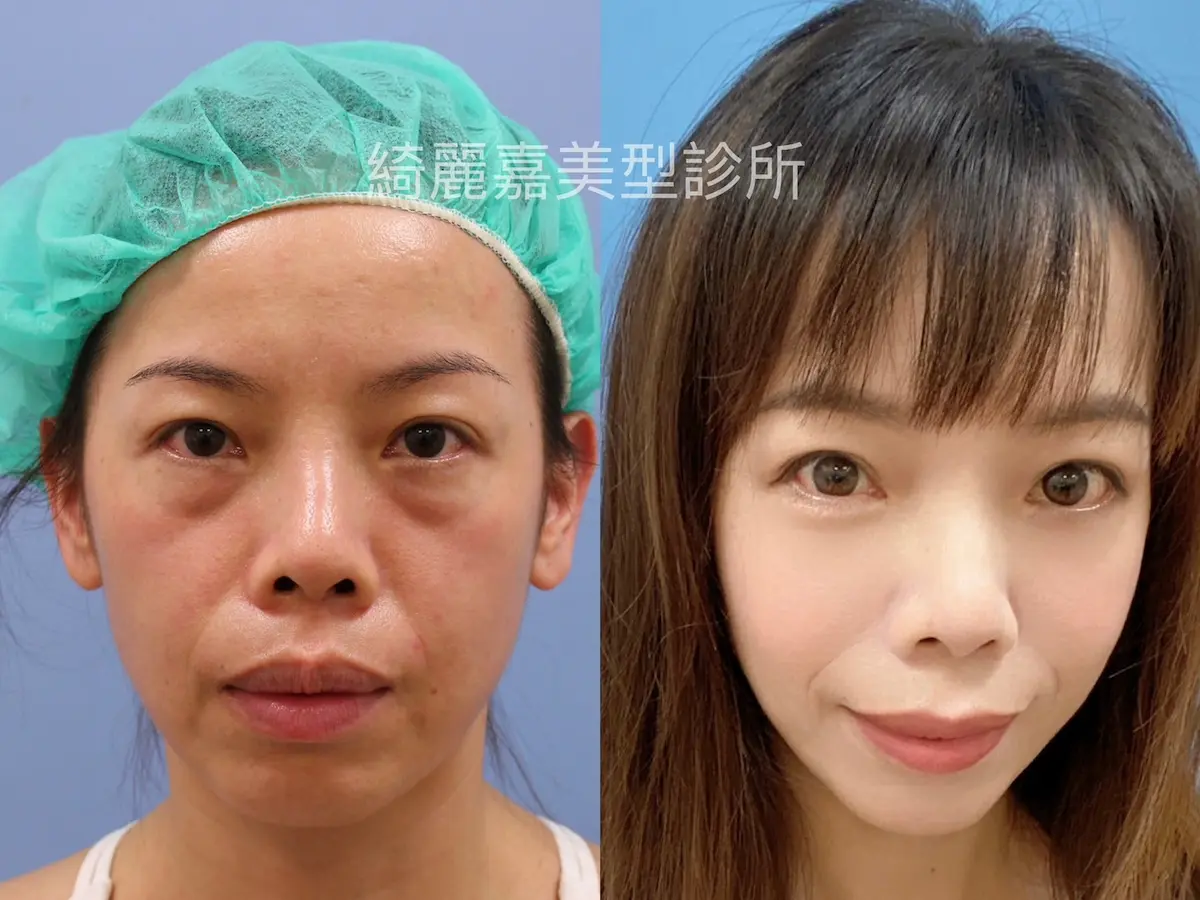 台北眼袋手術對比圖，眼袋改善與淚溝改善前後