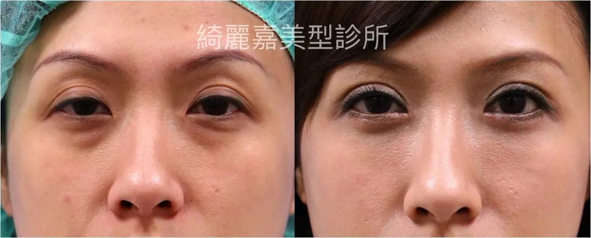 眼袋手術(淚溝改善),消除黑眼圈案例2