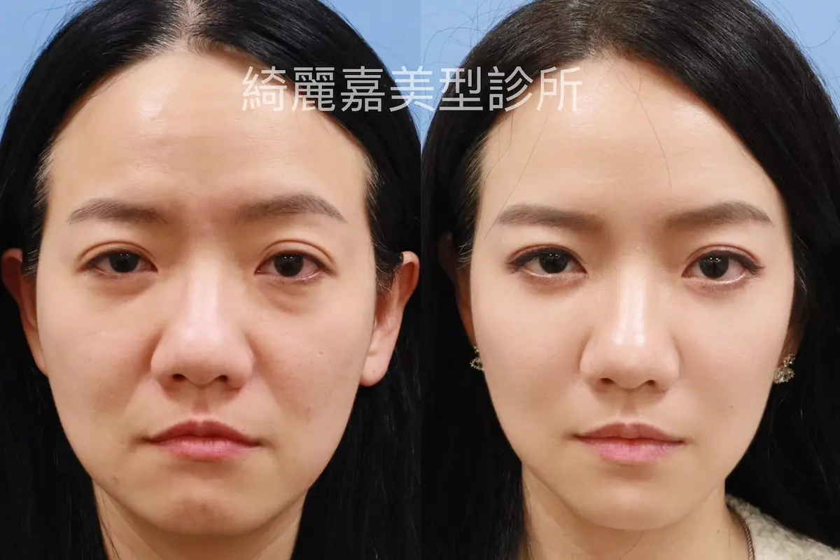 眼袋手術(淚溝改善),消除黑眼圈案例5