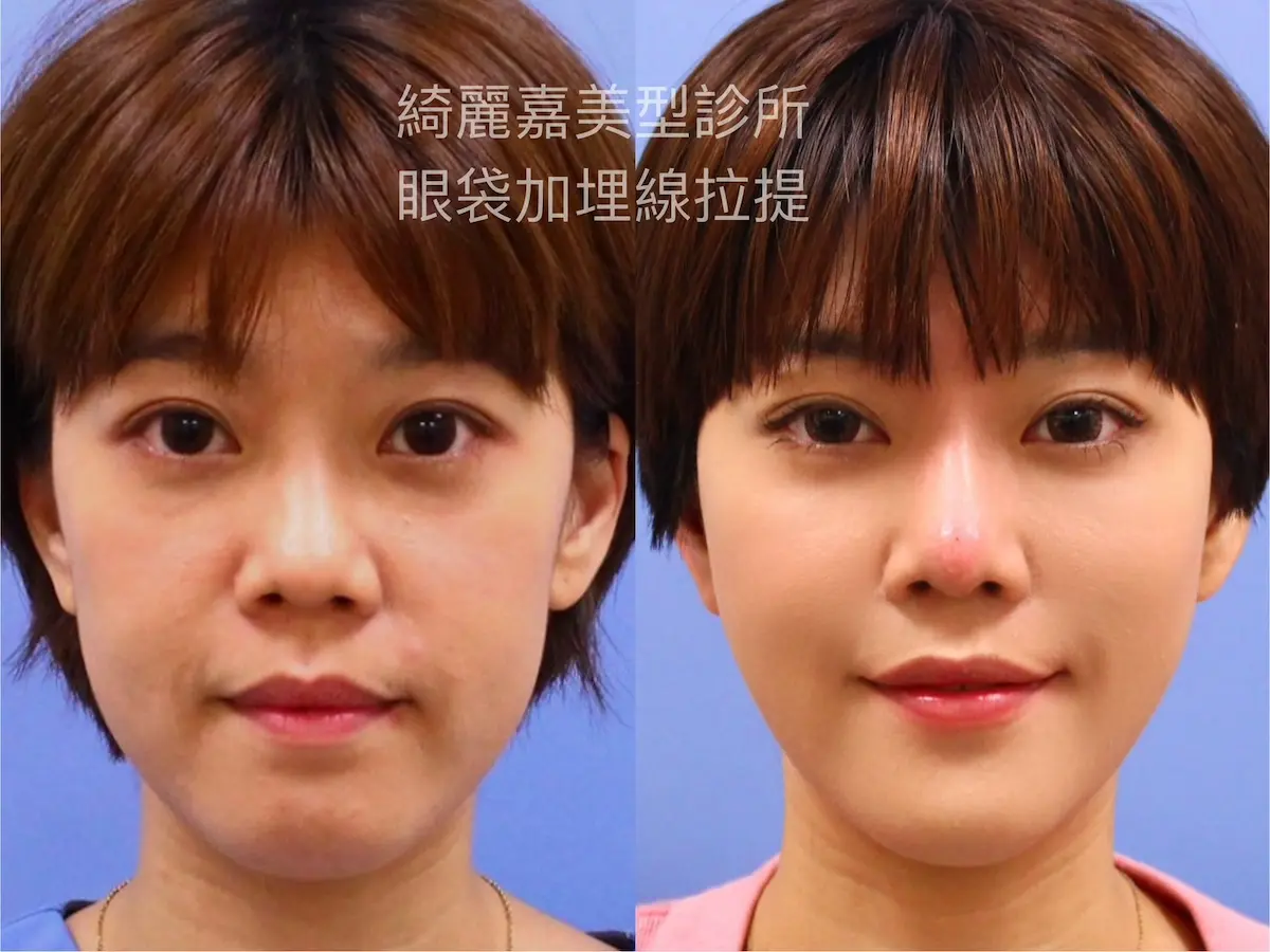 眼袋手術(淚溝改善),消除黑眼圈案例8
