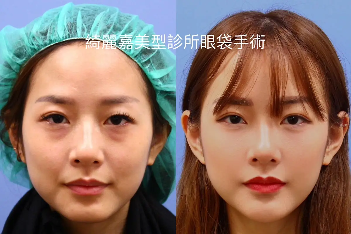 眼袋手術(淚溝改善),消除黑眼圈案例9