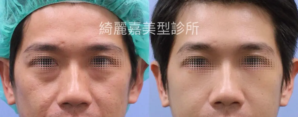 眼袋手術(淚溝改善),消除黑眼圈案例10