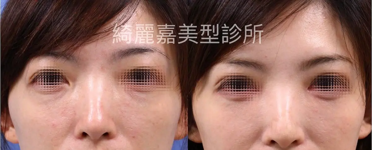 消除黑眼圈案例3