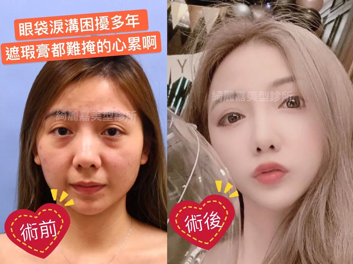 台北眼袋手術對比圖，眼袋改善與淚溝改善前後11