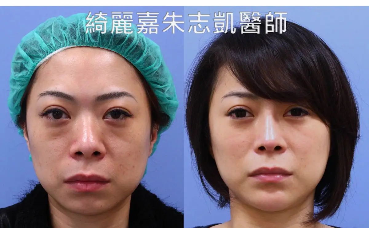 眼袋手術(淚溝改善),消除黑眼圈案例12