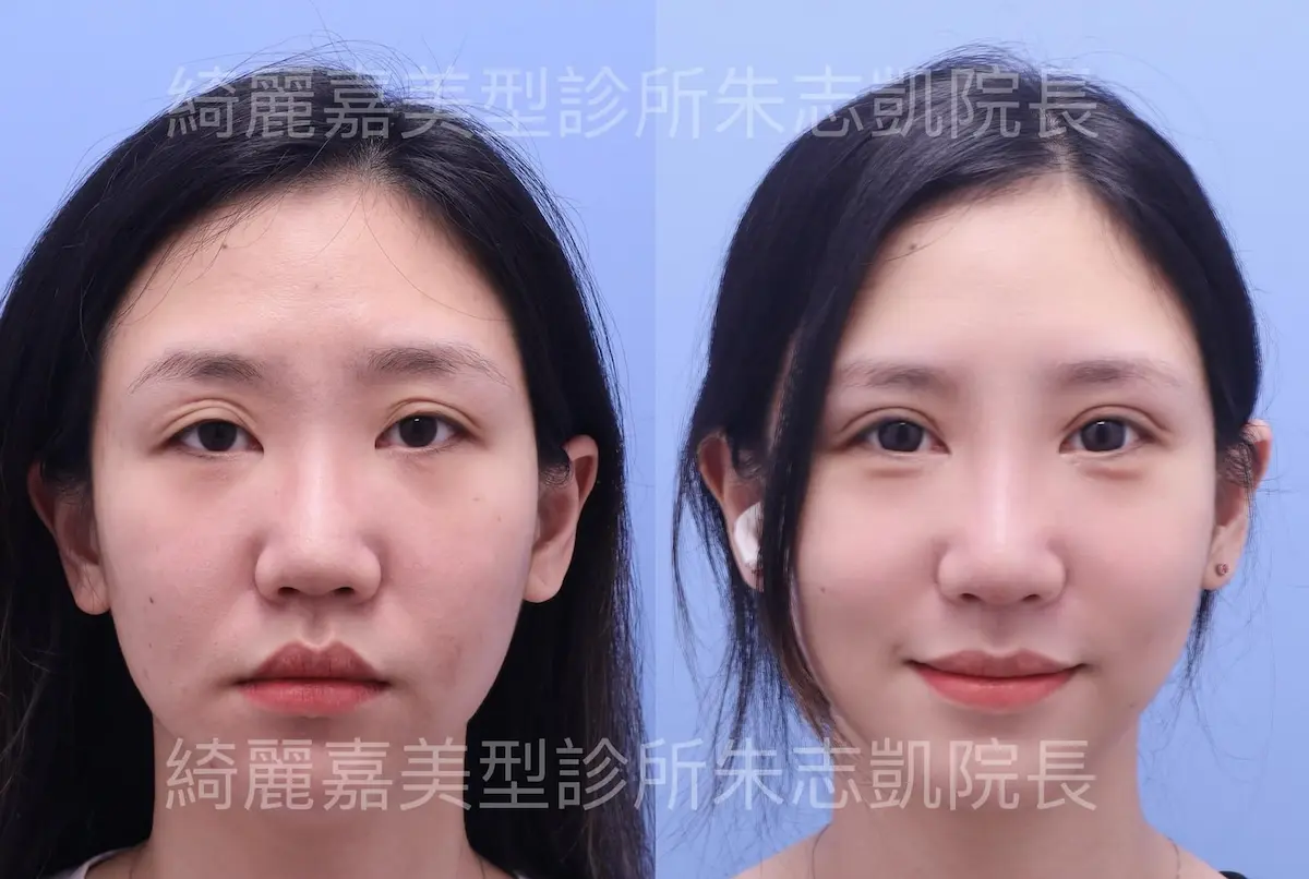 重修雙眼皮案例2