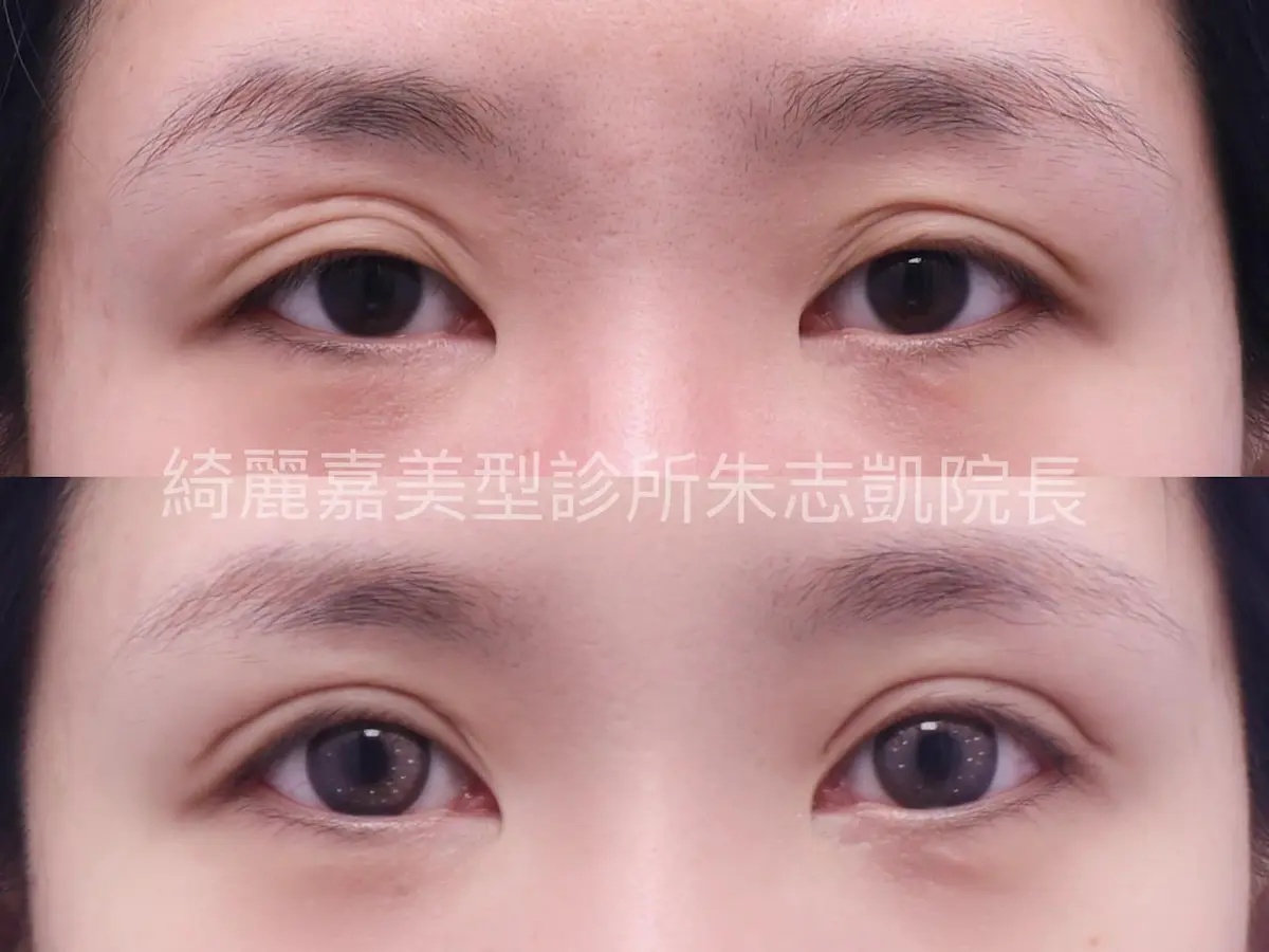 重修雙眼皮案例1
