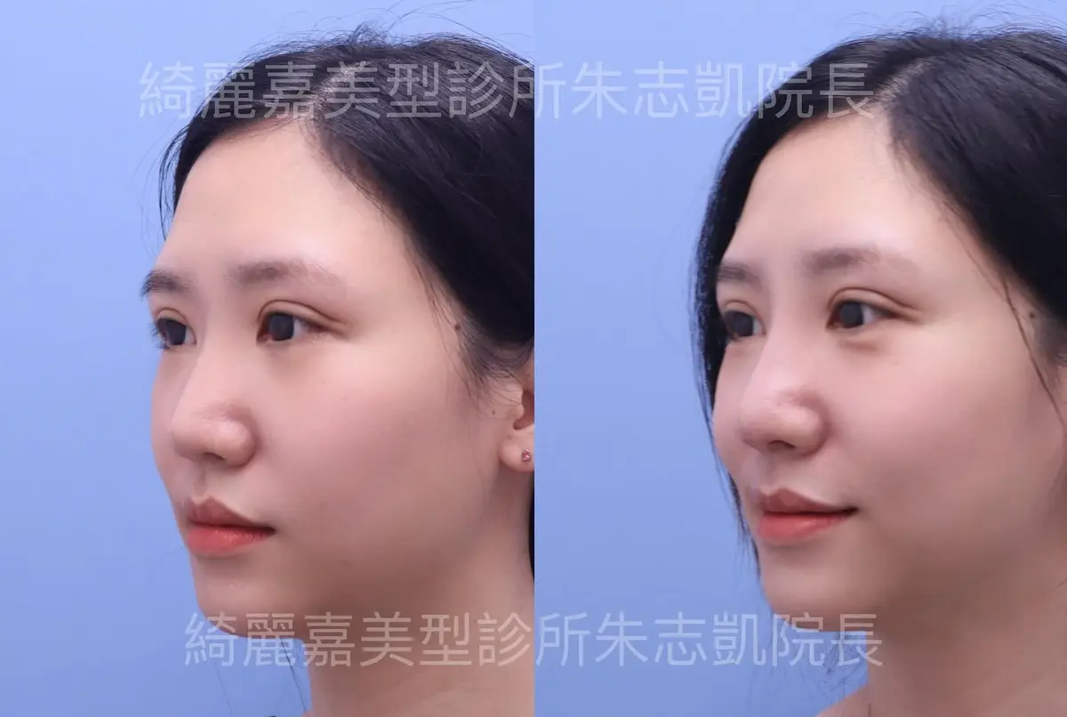 重修雙眼皮案例3