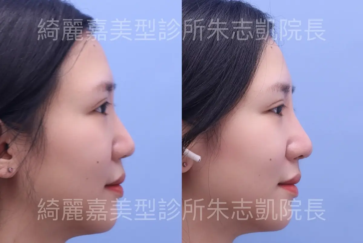 重修雙眼皮案例4