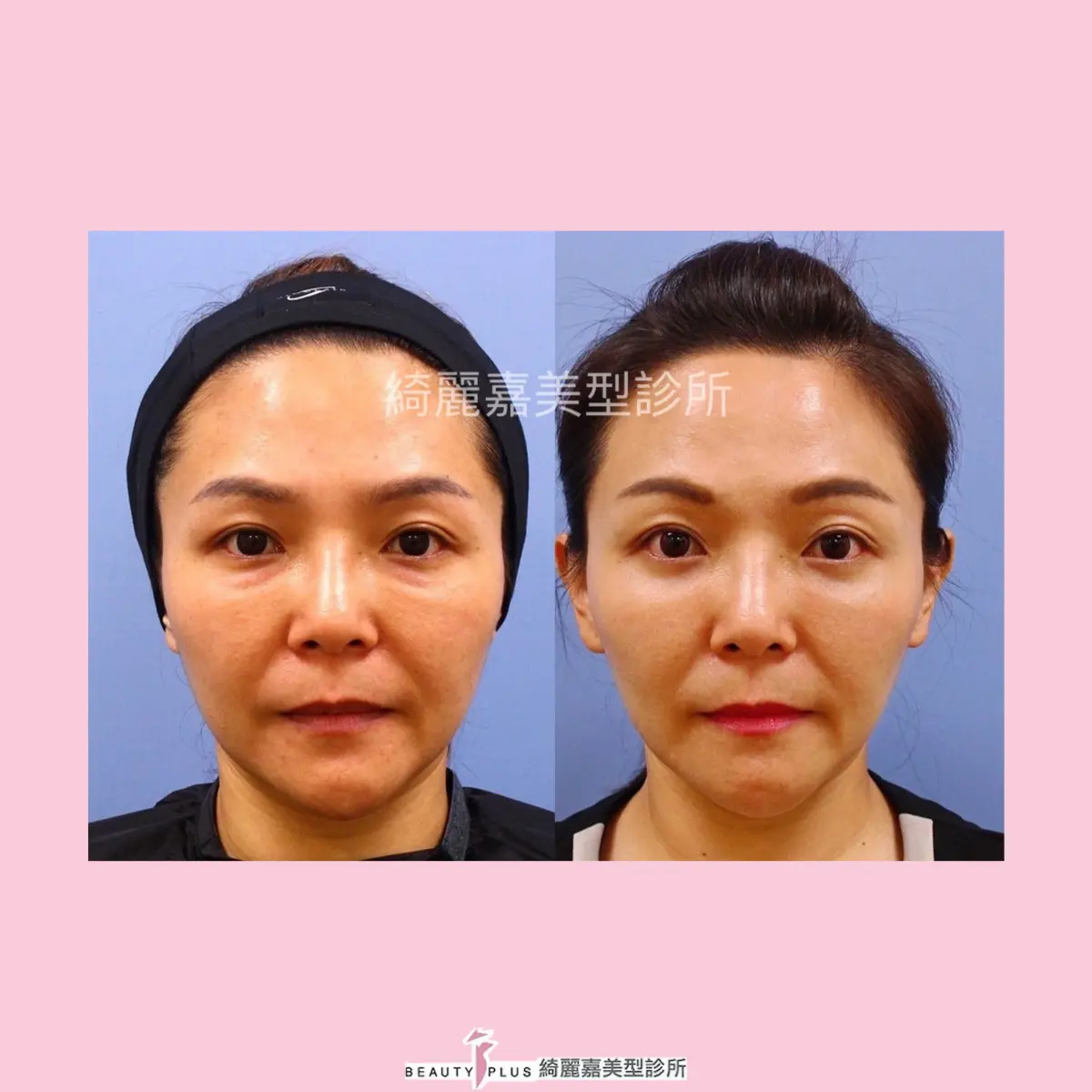 眼袋手術(淚溝改善),消除黑眼圈案例3