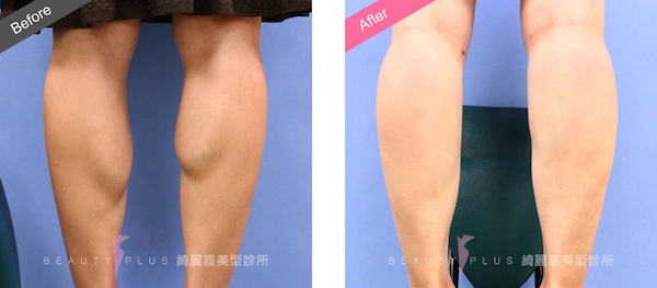 肉毒桿菌