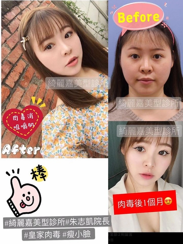 肉毒桿菌