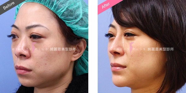 內開下巴手術 內開下巴手術