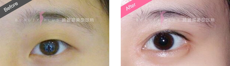 開眼尾及下置
