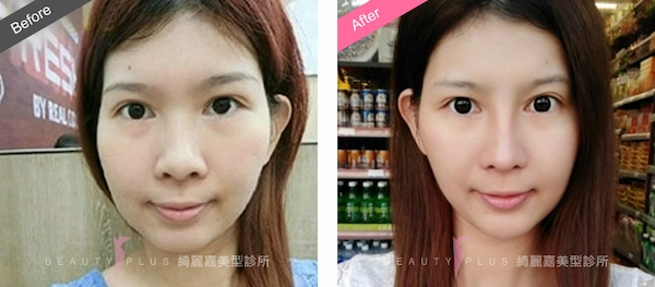 自體軟骨鼻整形 自體軟骨鼻整形