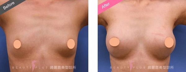 矽膠隆乳 矽膠隆乳