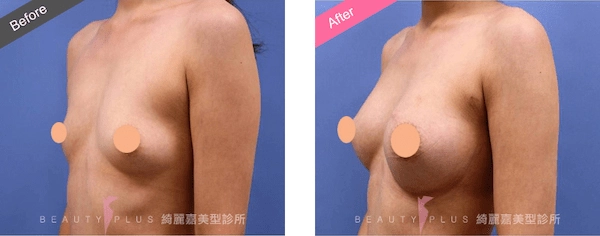 矽膠隆乳 矽膠隆乳