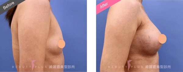 矽膠隆乳 矽膠隆乳