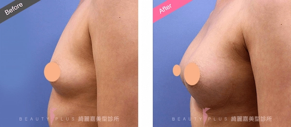 矽膠隆乳 矽膠隆乳