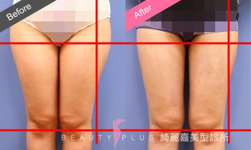 脂肪雕塑 脂肪雕塑
