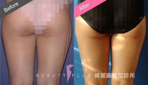 脂肪雕塑 脂肪雕塑