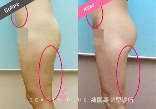 脂肪雕塑 脂肪雕塑