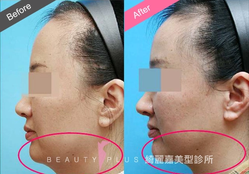 脂肪雕塑 脂肪雕塑