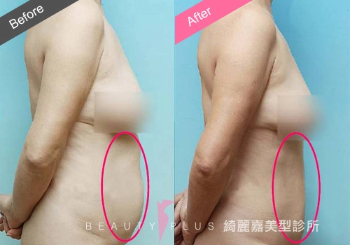 脂肪雕塑 脂肪雕塑