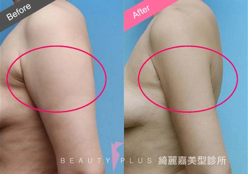 脂肪雕塑 脂肪雕塑