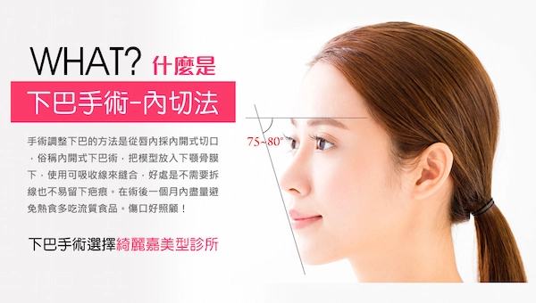 內開下巴手術 內開下巴手術