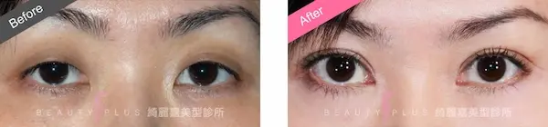 縫雙眼皮手術案例1