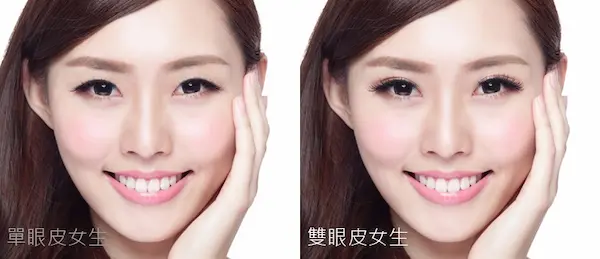 單眼皮與雙眼皮結構示意
