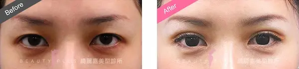 縫雙眼皮手術案例3