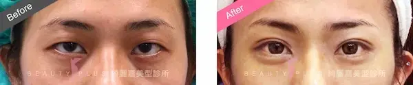 縫雙眼皮手術案例7
