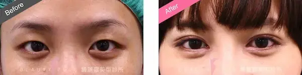 縫雙眼皮手術案例8