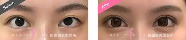 割雙眼皮手術案例