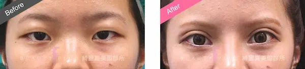割雙眼皮手術案例5