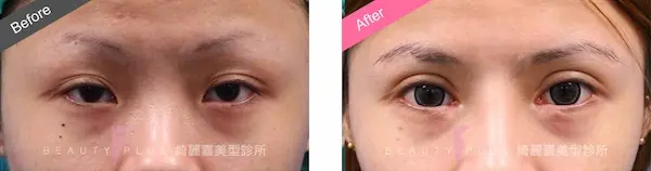 割雙眼皮手術案例6