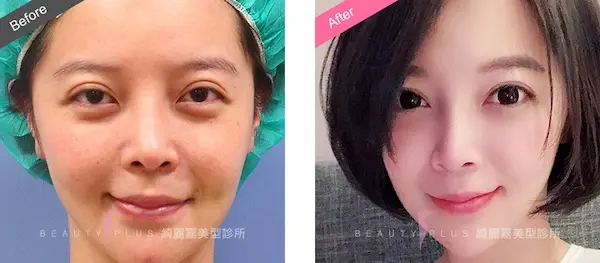 割雙眼皮手術案例7