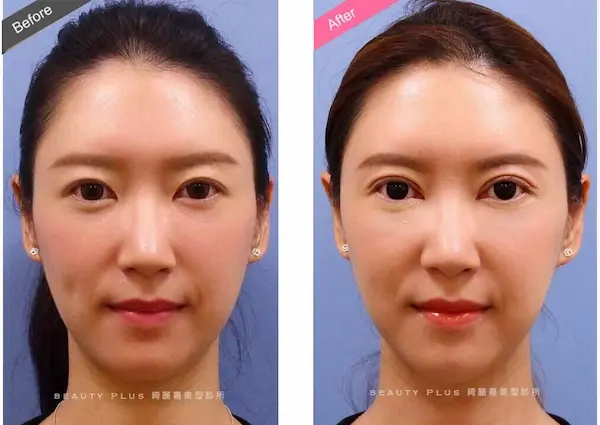 割雙眼皮手術案例8