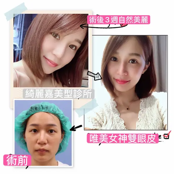 術後三周美麗自然
