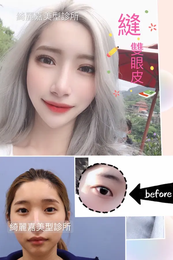 縫線式雙眼皮手術，術後自然