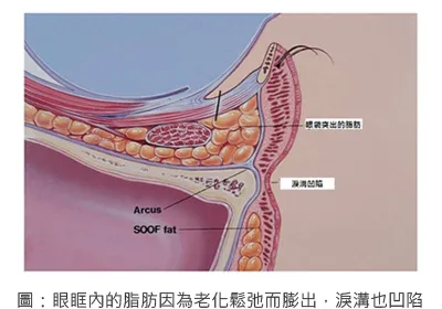 眼袋/淚溝/黑眼圈形成原因